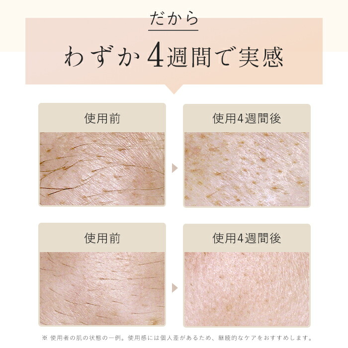 楽天市場】週末はP20倍でお得☆楽天1位☆IPL光美容器Luna（ルナ）脱毛