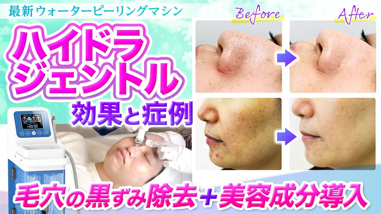 症例アリ】ハイドラジェントルの効果とハイドラフェイシャルとの違い