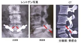 腰椎分離症 | 間庭整形外科